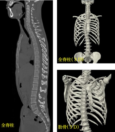 全脊柱、肋骨のCT検査画像の見本