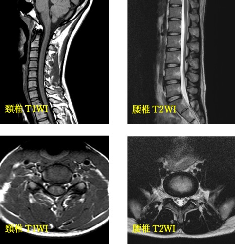 頸椎、腰椎のMRI検査画像の見本